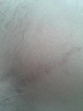 Strie / jizva?